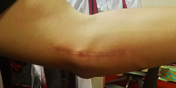 Diamondbacks’ pitcher Patrick Corbin shows the scar his 2014 Tommy John surgery left on his left ...