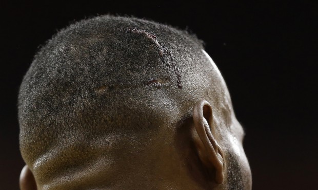 A wound is seen on the head Cleveland Cavaliers forward LeBron James (23) during the second half of...